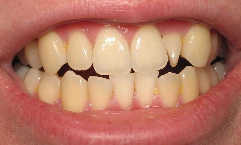 A patient's teeth before Invisalign