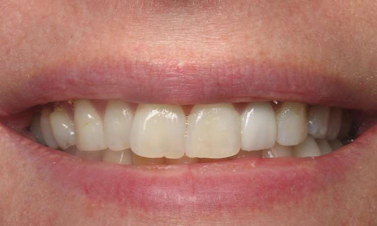 Close up before picture of a patient before Invisalign and Teeth Whitening treatment