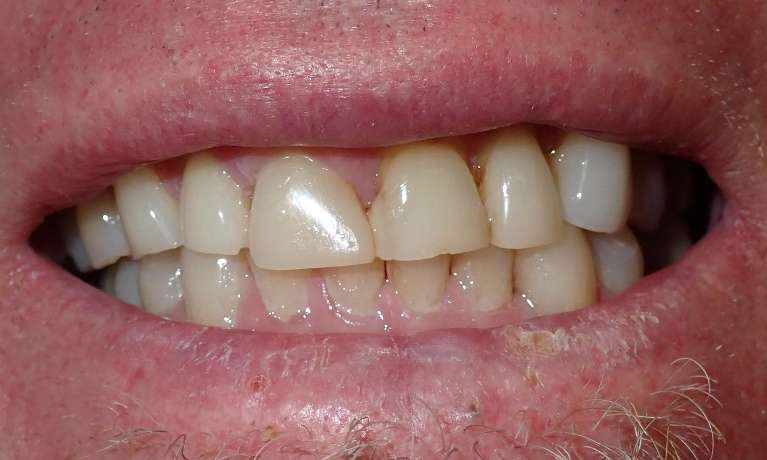 Photo of a patient's teeth before getting Porcelain Crowns