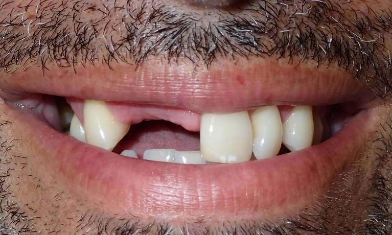 A photo of patient's teeth before dental implant in Audubon, NJ.
