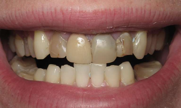 A photo of a patient before getting Porcelain veneers in Audobon, NJ