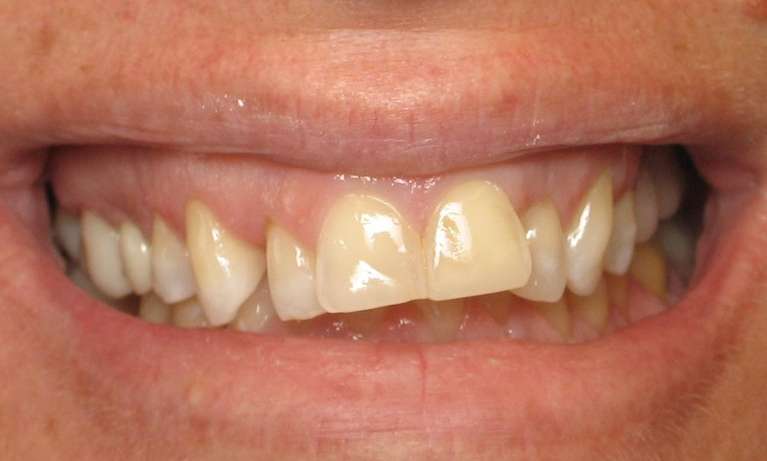 Patient's teeth before using Porcelain Veneers in Audubon, NJ.