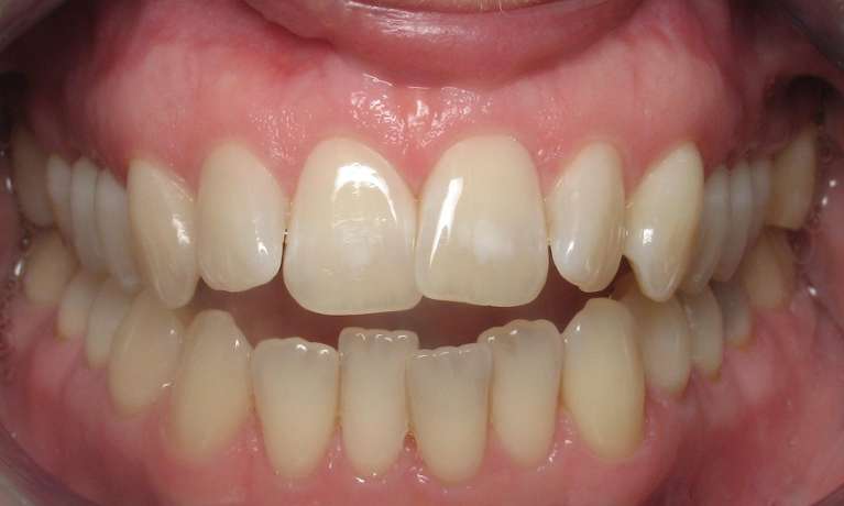 A close up Before picture of a patient with an open Bite
