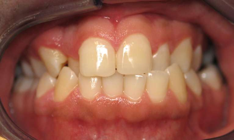 Patient's teeth before Invisalign