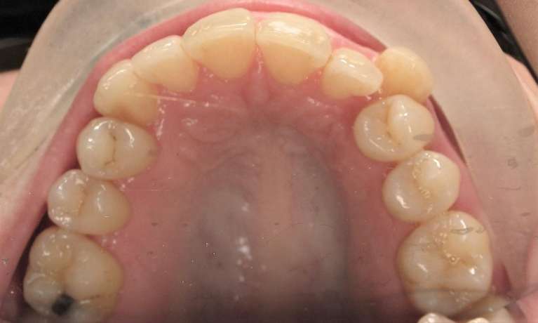 Patient's teeth before getting Invisalign clear aligners