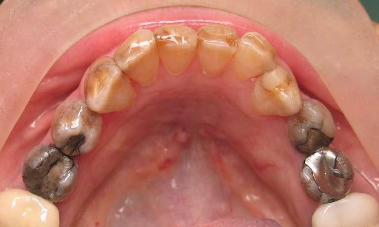 A photo of a patient's worn teeth before getting Porcelain crowns at Train Station Dental, NJ