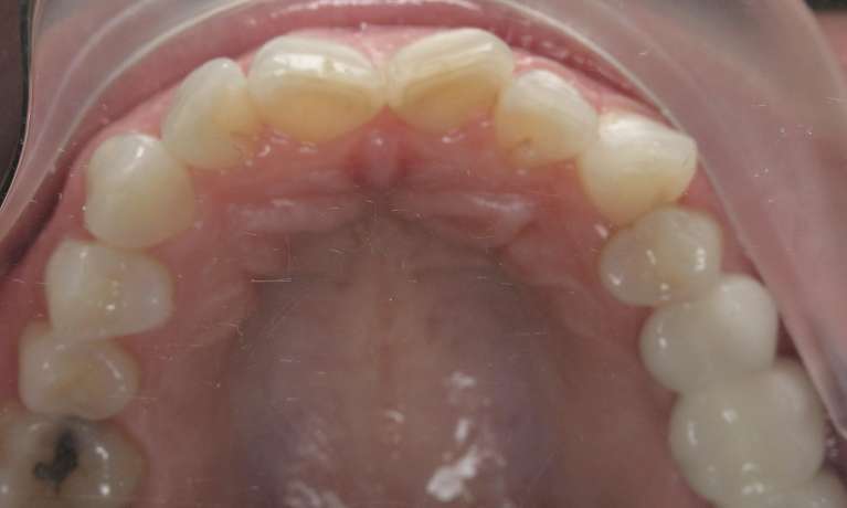 Patient's teeth before porcelain veneers and Invisalign