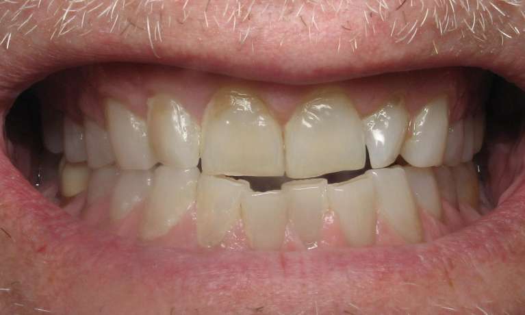 Photo of a patient before getting porcelain veneers in Train Station Dental, NJ