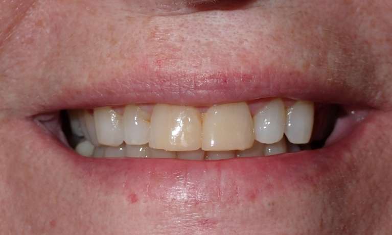 Patient's teeth before getting porcelain veneers