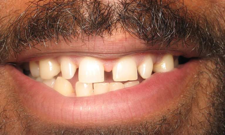 Patient's teeth before space closure