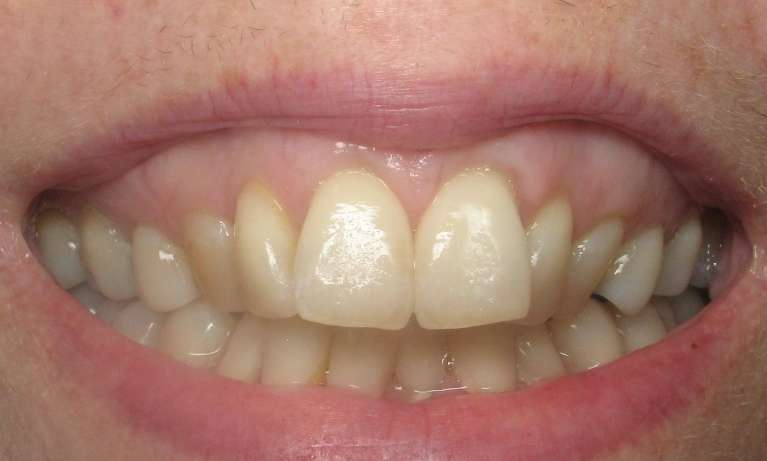 Photo of patient's teeth before Invisalign in Audubon,Nj